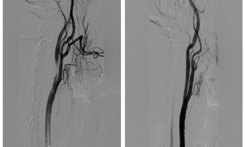 Carotid Angioplasty and Stenting