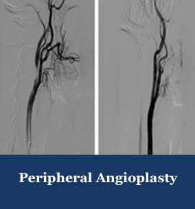 angioplasty
