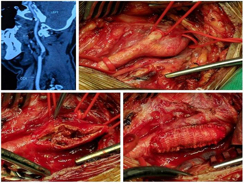 carotid_enderectomy