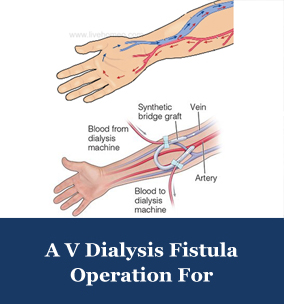 dialysis