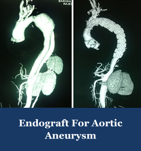 endovascular