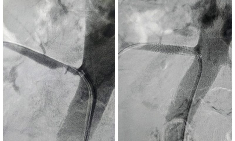 renal-angioplasty