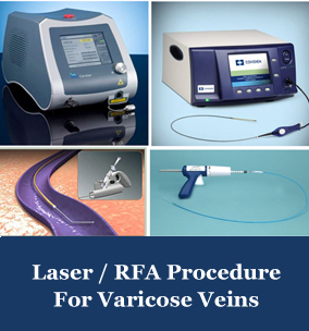 varicose