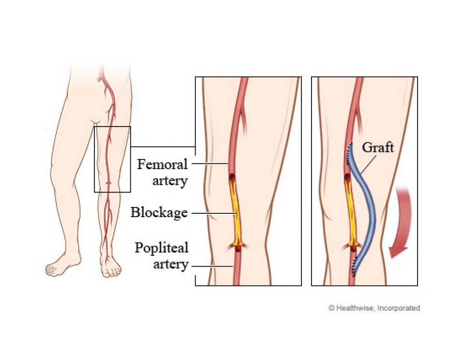 PERIPHERAL ARTERY BYPASS