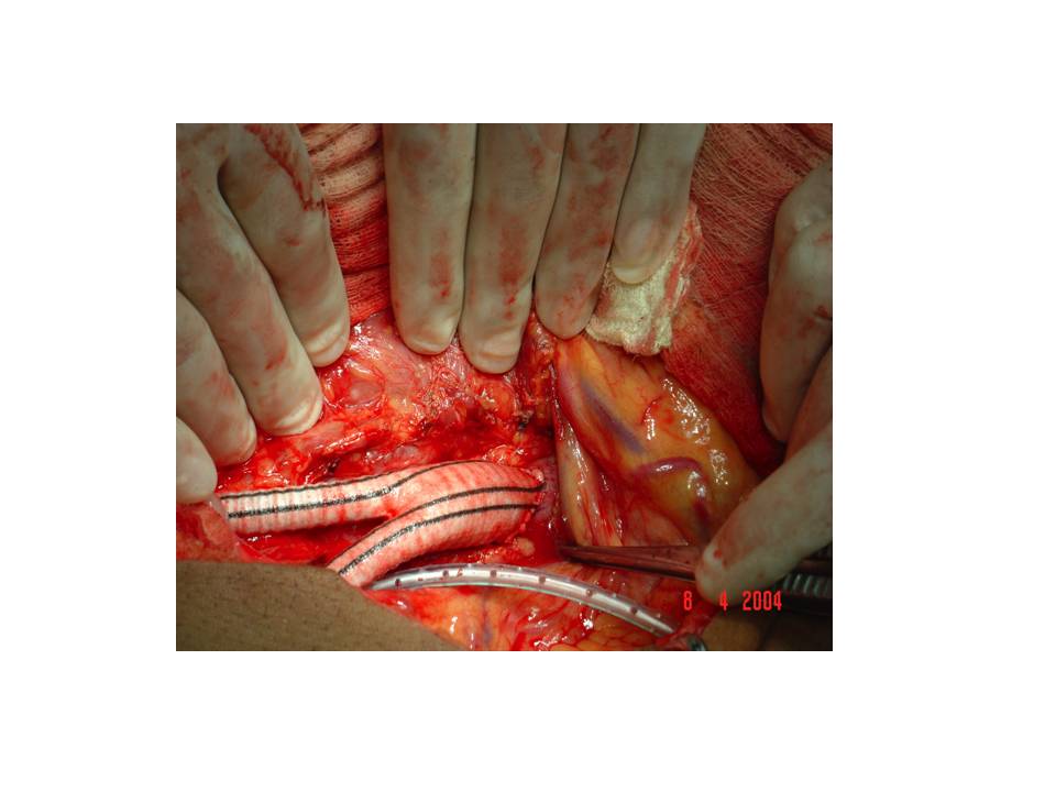 PERIPHERAL ARTERY BYPASS